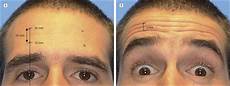 Plastic Injections