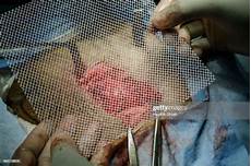 Surgical Polypropylene Mesh